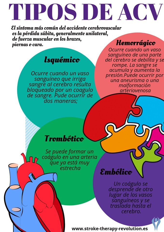 Todo lo que debes saber sobre el ictus