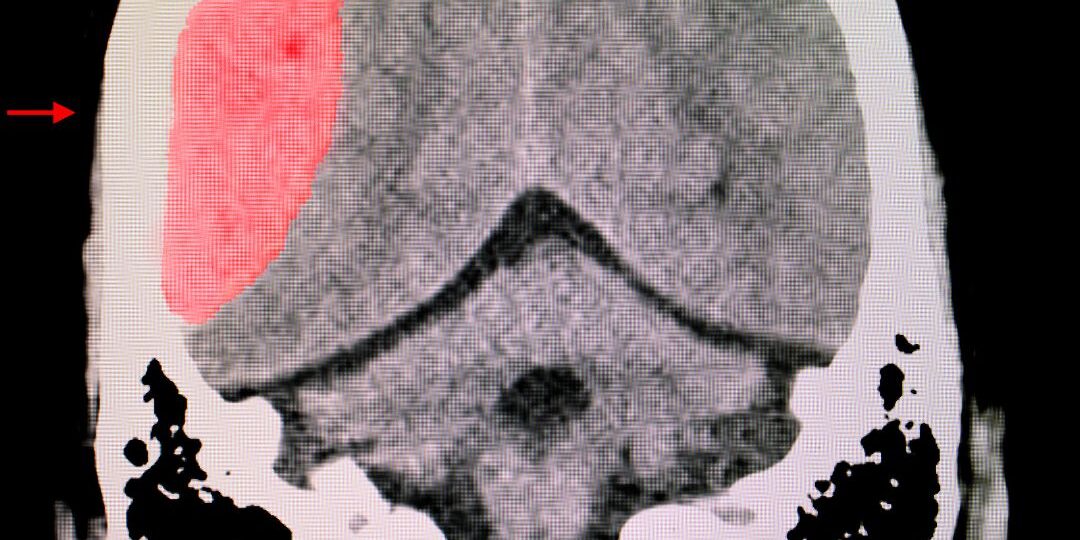 Lesión cerebral