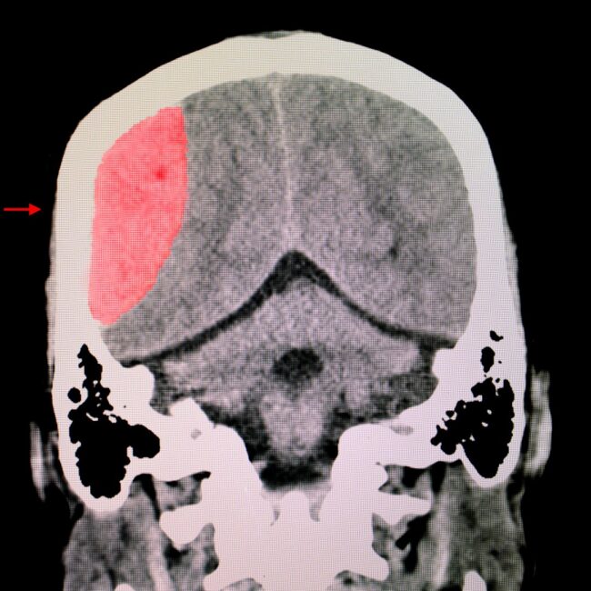 Lesión cerebral