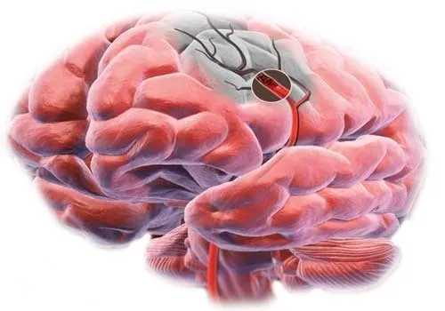 isquemia+cerebral-640w