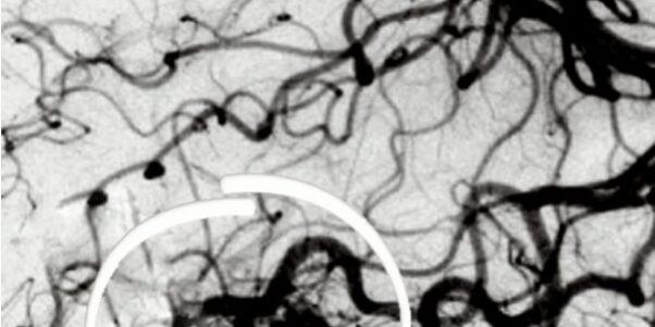 Malformacion-Arteriovenosa-MAV