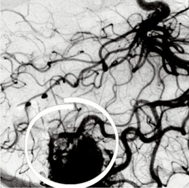 Malformacion-Arteriovenosa-MAV