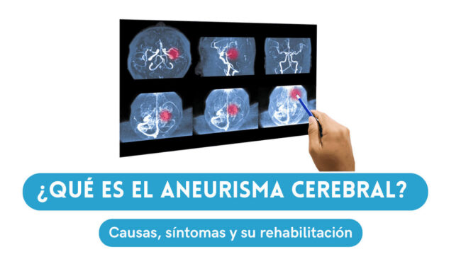 QUE ES EL ANEURISMA