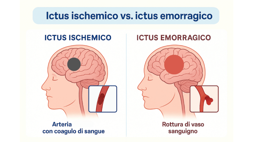 Schema comparativo tra ictus ischemico ed emorragico nel cervello